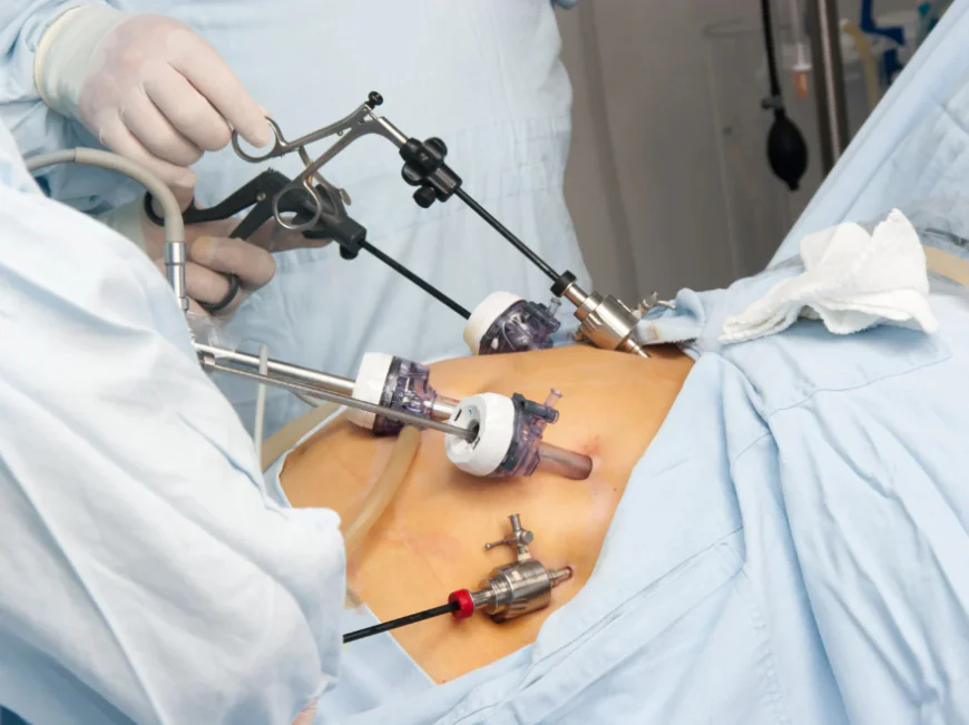 What Is Laparoscopic Surgery in Gynaecology?