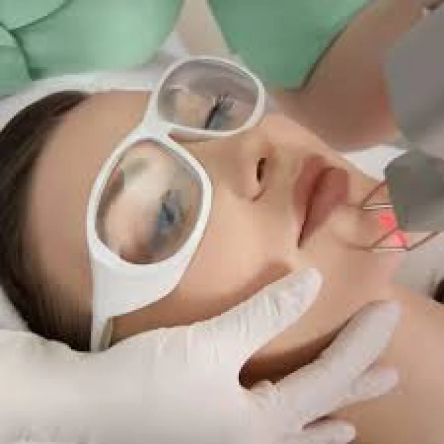 Fractional CO2 Laser Treatment in Dubai for Acne Scars