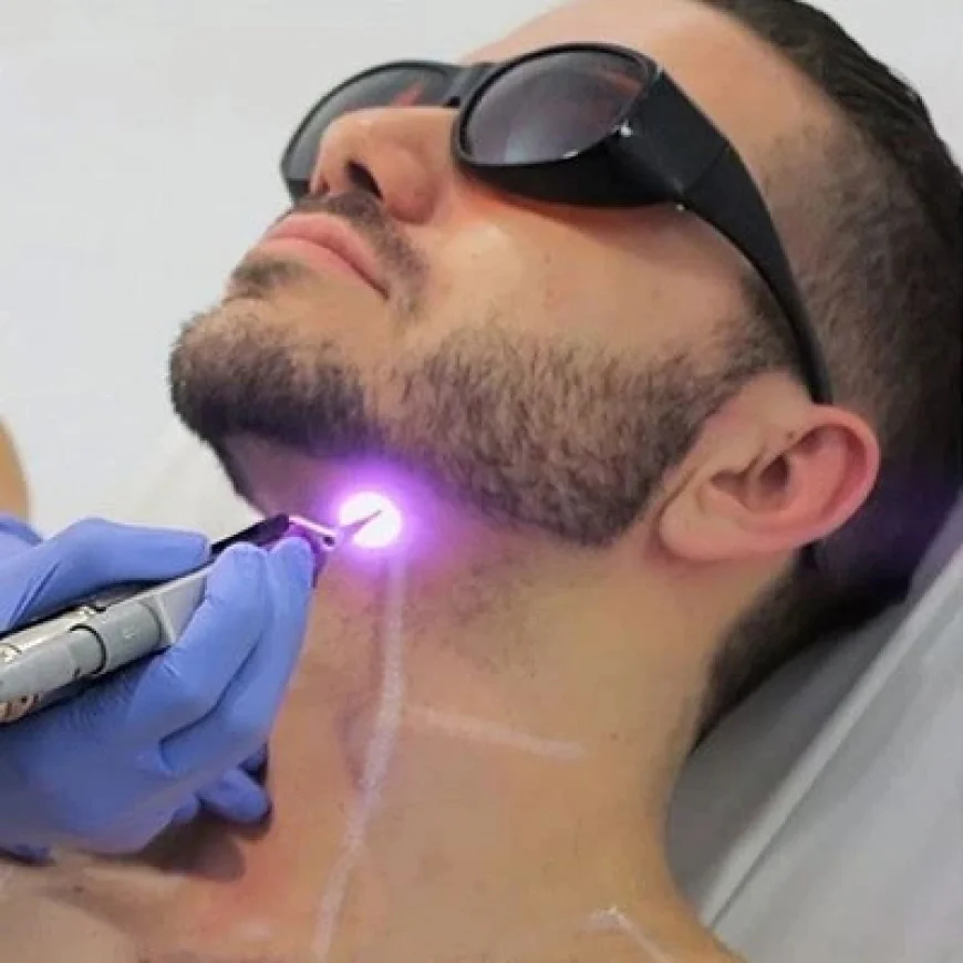 Is Beard Laser Hair Removal Worth It?