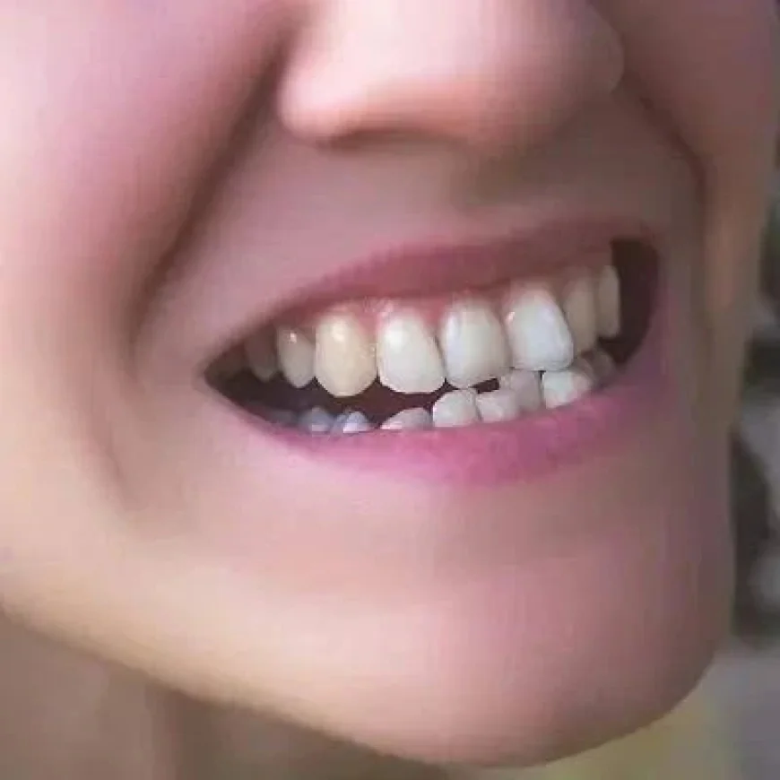 Crooked Teeth Treatment Using Modern Dental Techniques | Glamorous Clinic Dubai