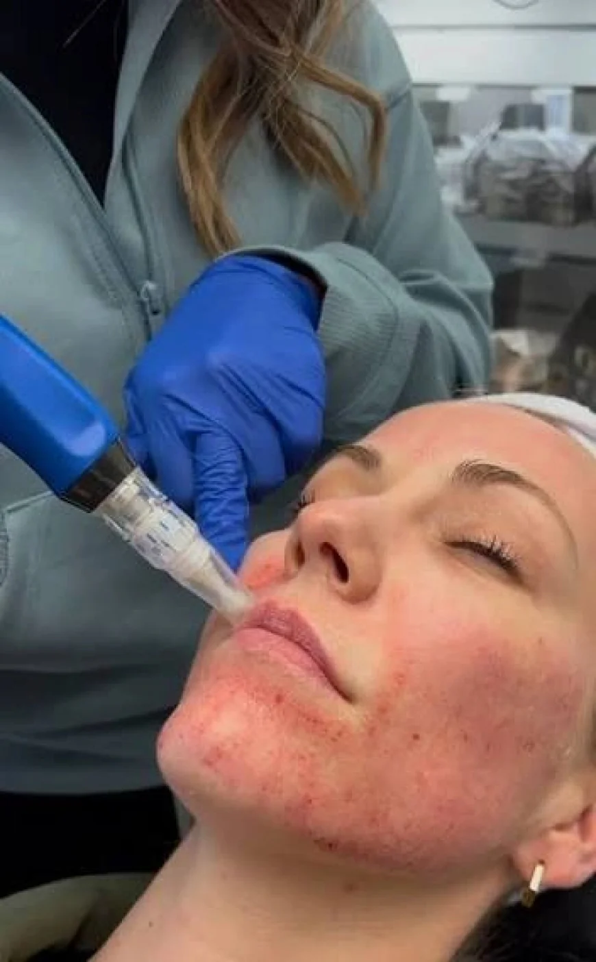 Is Microneedling Treatment Good for Acne Scars?