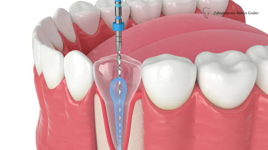 Root Canal Treatment: Saving Your Natural Tooth