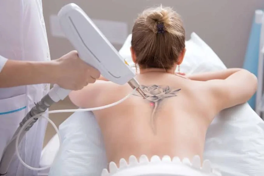 What Makes Laser Tattoo Removal Work So Well?