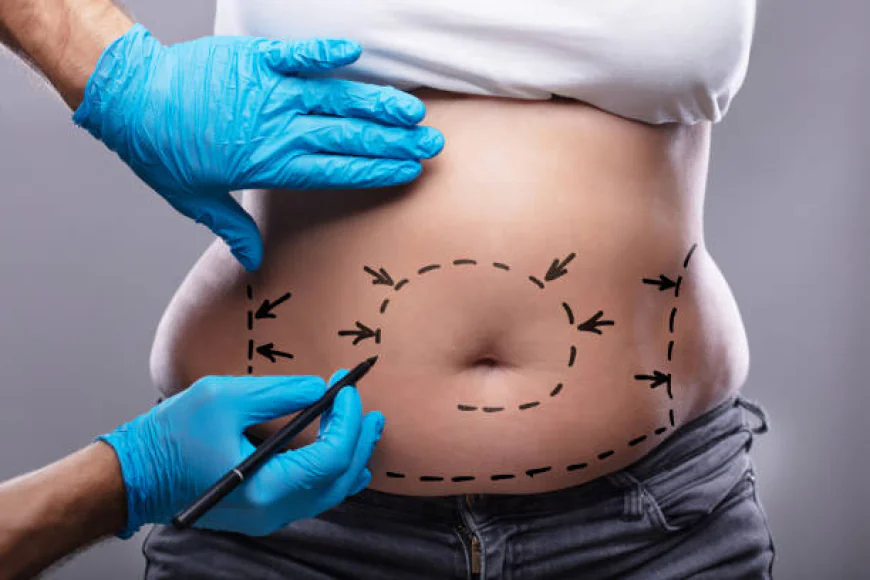 How Can Tummy Tuck Improve Proportions Around the Abdomen?