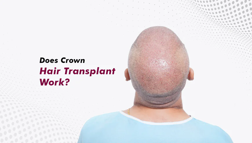 Best Hair Transplant in Gurgaon: How to Choose the Right Clinic and Treatment