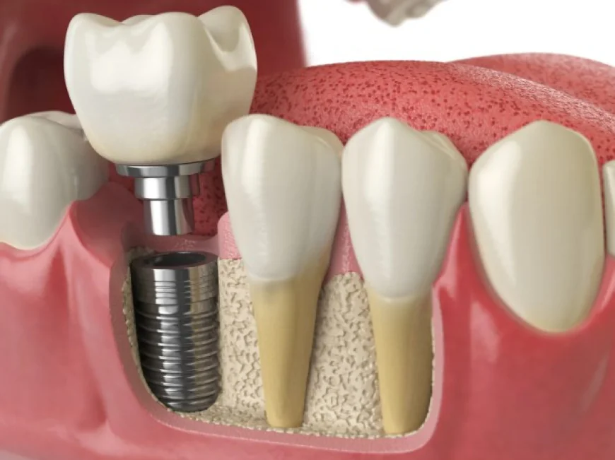 What Makes the Best Dental Implants Lahore a Good Choice?