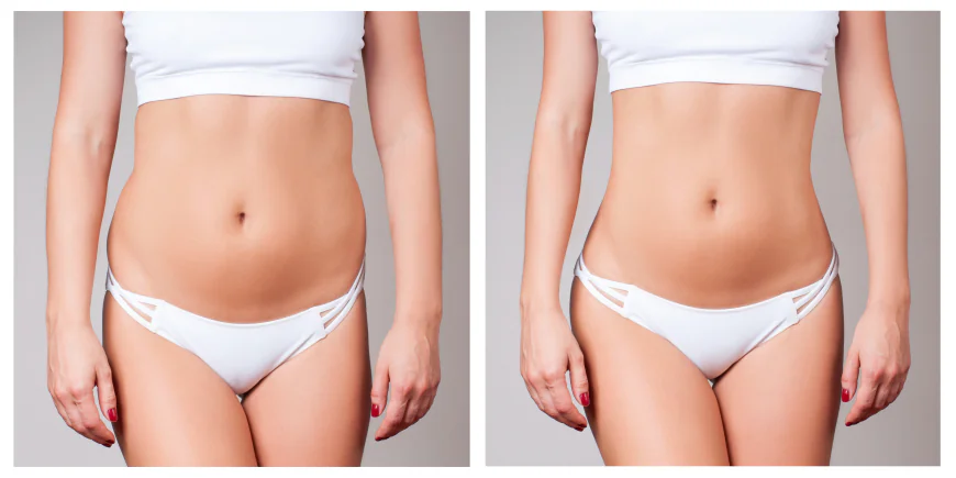 Liposuction in Islamabad: Why Choosing the Right Clinic Matters