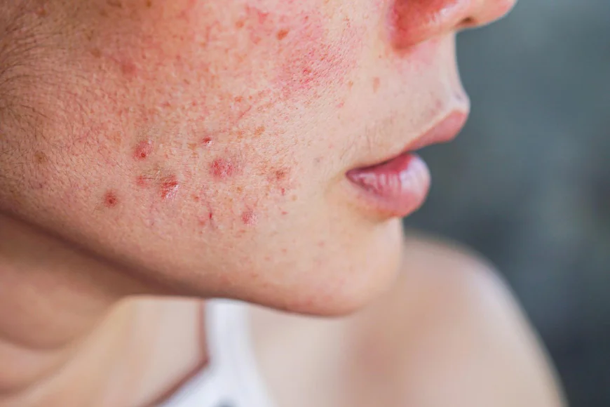 How Soon Can Acne Treatment Show Visible Skin Results?