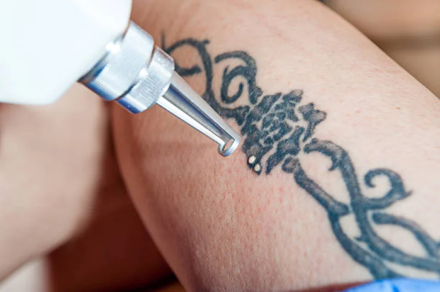 What makes Laser tattoo removal a popular ink removal option?