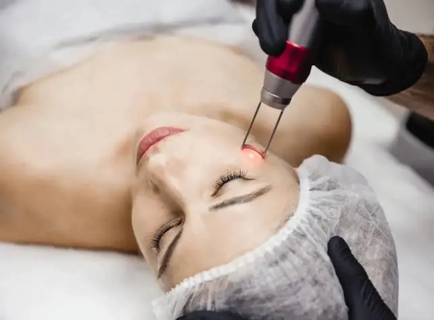 Is Pico Laser Treatment Good for Acne Marks?