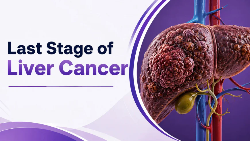 What Is the Last Stage of Liver Cancer?