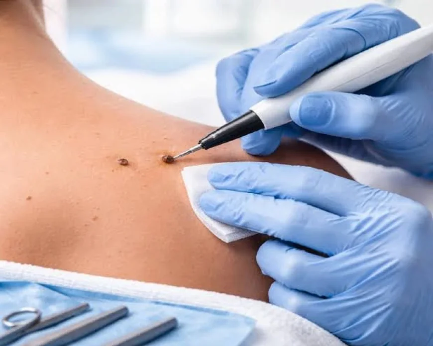 Is Skin Lesion Removal Right for You Today?