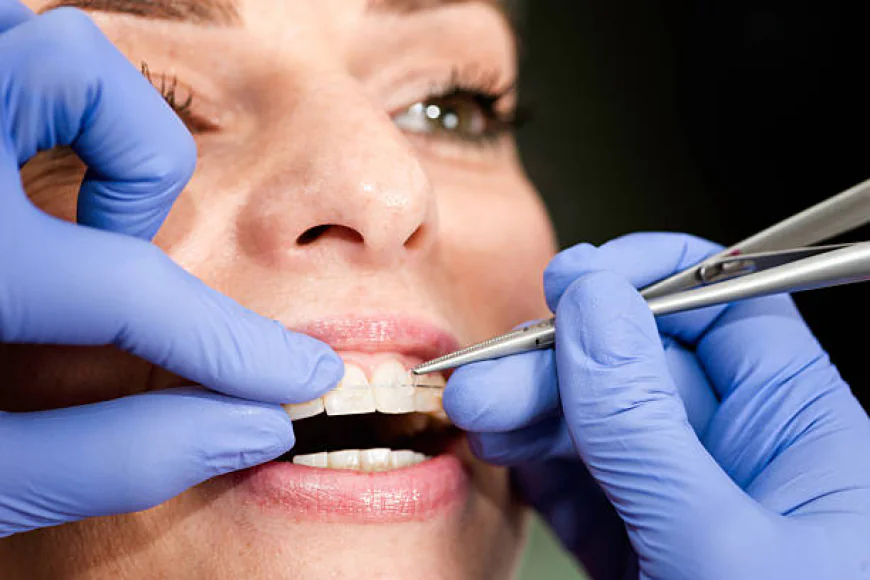 Ceramic Braces: Benefits and What to Expect