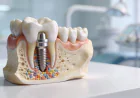 Dental Implants vs Bone Grafting: What Your Oral and Maxillofacial Surgeon Recommends