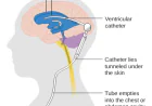 Hydrocephalus Shunts Market Size, Growth, and Strategic Insights 2026-2033