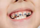 Dental Braces: Benefits, Types and What to Expect