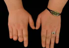 Finger Prosthetics for Every Lifestyle: Matching the Right Device to What You Actually Do