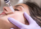 What Results Can Laser Skin Tightening Give?