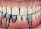 Experience the Confidence of Complete Teeth with All on 4 Implants