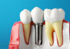 Dental Implants Explained as the Foundation for Lasting Smiles