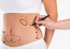 What Are the Different Types of Tummy Tuck?