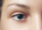 Is Eyelid Surgery Used for Puffy Lower Eyelids?