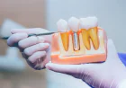 The Rise of Dental Implants as the Preferred Tooth Replacement Option