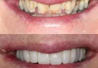 Can Composite Veneers Sydney Create a More Confident Smile? | Timeless Smiles Dental
