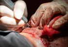 Is FUSS Hair Transplant in Dubai Suitable for Older Adults