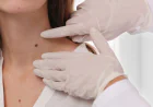 What Factors Matter in Skin Tag Treatment?