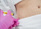 Can Fat Reduction Treatments in Islamabad Help Refine Stubborn Fat Areas?