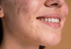 Why Does Acne Keep Coming Back Even After Treatment?