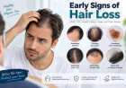 Early Signs of Hair Loss You Should Not Ignore
