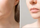 How to Care for Incisions After Chin Reduction