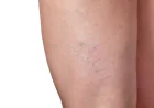 Spider Veins Treatment In Dubai: Advanced Care for a More Even-Looking Leg Appearance