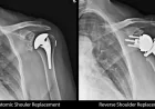 Shoulder Surgeon in Troy MI | Advanced Treatment for Shoulder Injuries