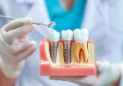 Dental Implant Treatment in Goregaon: What Happens to Your Jaw After a Tooth Goes Missing