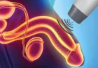 Penile Shock Wave Therapy in Lucknow: Procedure, Benefits and Considerations