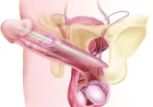 Penile Implant Surgery in Lucknow: Types, Procedure, Benefits and Recovery