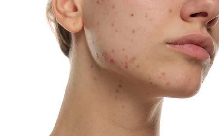 Is Laser Acne Scar Treatment good for mature scars
