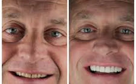How Does Non-Surgical Jaw Correction Work for Bite and Jaw Alignment?