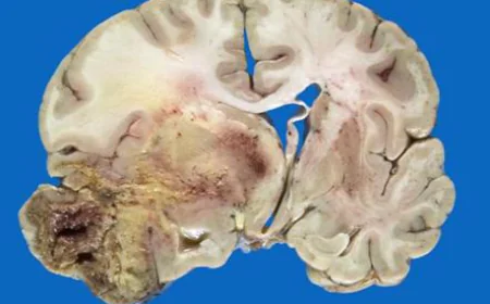 Glioblastoma Market: Size, Trends, and Strategic Outlook to 2033