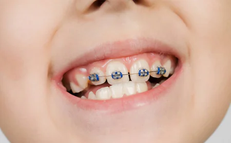 Dental Braces: Benefits, Types and What to Expect
