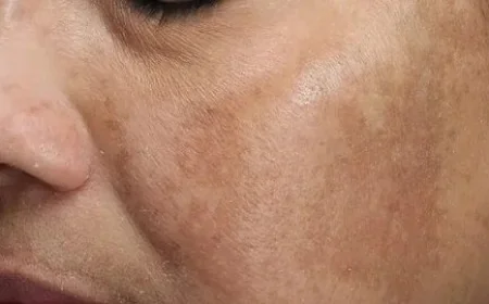 Can Melasma Treatment Help With Hormonal Dark Patches