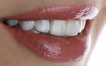 What to Expect From Dental Veneers