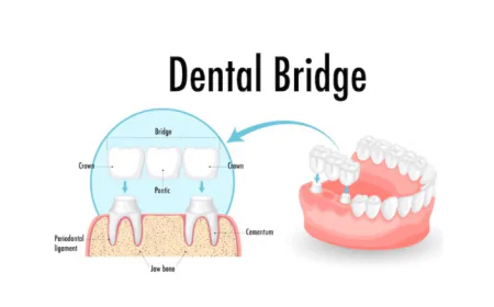 Porcelain Teeth Bridge: Uses, Benefits, and Care Tips