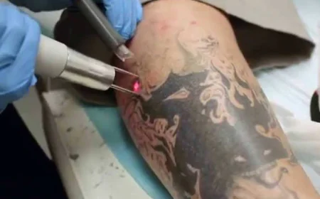 What should you know before choosing Laser tattoo removal?