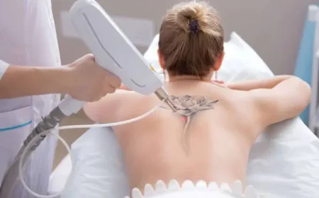 How Does Laser Tattoo Removal Address Tattoo Ink?