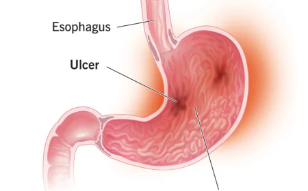 Evolving Dynamics in the Gastritis Treatment Market: Size, Growth, and Strategic Outlook
