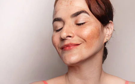 What Can Melasma Treatment Do for Your Complexion?